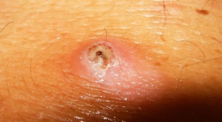 Strongyloidiasis parasitic under the skin