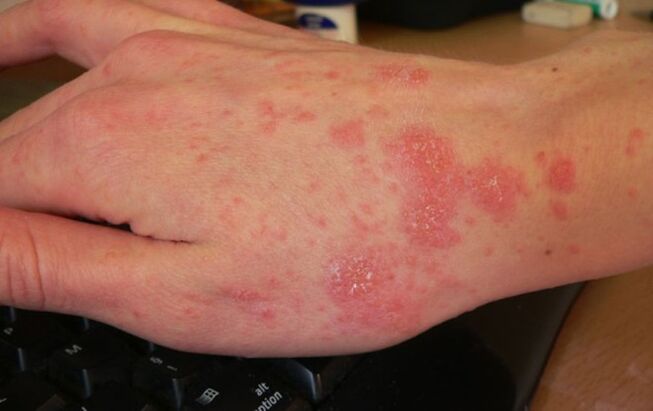 scabies has parasites under the skin