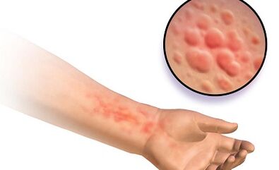 The manifestation of Schistosomosis in humans